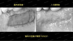 歯肉移植の経過です。術前術後で経過がわっきりわかります