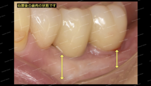 歯肉移植後の経過です。周囲の歯肉と馴染んでいます。