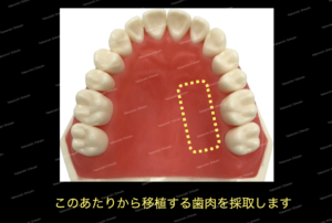 歯肉の移植は上顎の内側あたりから採取することが多いです。
