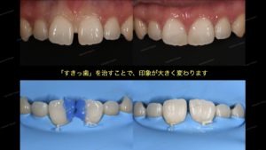 すきっ歯（正中離開）の治療〜ダイレクトボンディング審美治療〜１１