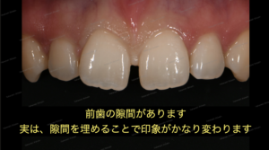 すきっ歯（正中離開）の治療〜ダイレクトボンディング審美治療〜２