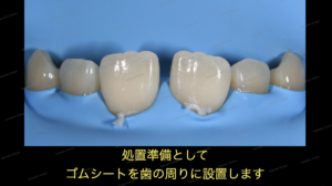 すきっ歯（正中離開）の治療〜ダイレクトボンディング審美治療〜４