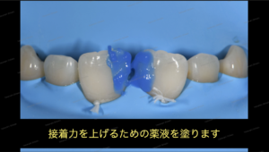 すきっ歯（正中離開）の治療〜ダイレクトボンディング審美治療〜５