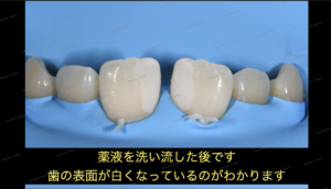 すきっ歯（正中離開）の治療〜ダイレクトボンディング審美治療〜５
