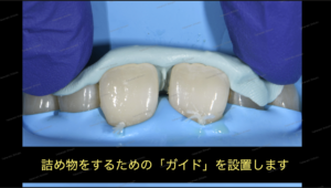 すきっ歯（正中離開）の治療〜ダイレクトボンディング審美治療〜７