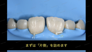 すきっ歯（正中離開）の治療〜ダイレクトボンディング審美治療〜８