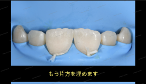 すきっ歯（正中離開）の治療〜ダイレクトボンディング審美治療〜10