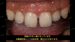 すきっ歯の治療；ダイレクトボンディング治療とは