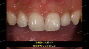すきっ歯の治療；ダイレクトボンディング治療とは