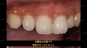 すきっ歯の治療；ダイレクトボンディング治療とは
