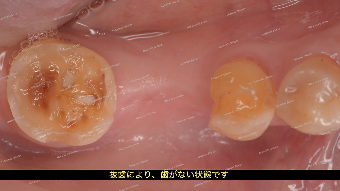 インプラント治療
