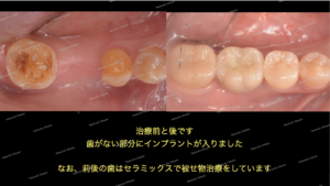 インプラント治療のビフォーアフターです。インプラントの前後の歯はセラミックスで治療をしています。