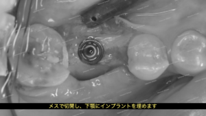 メスで切開し、インプラントを埋入します