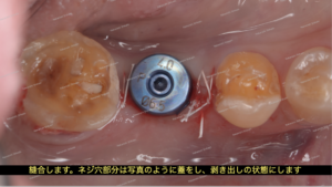 インプラントを埋入し、約２ヶ月待ちます
