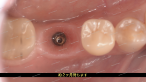 インプラントを埋入し、２ヶ月待ちます。