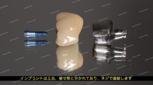 インプラントは土台、被せ物と分かれており、ネジで止める仕組みです