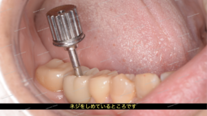 インプラントの被せ物を装着し、ネジを締めているところです。