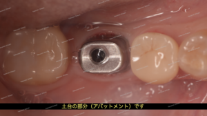 インプラントの土台部分が入った状態です（アバットメントといいます）