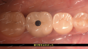 インプラントの被せ物が入った状態です。中央の黒い穴はネジ穴部分です。