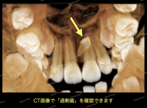 CT画像で、埋伏過剰歯の状態が確認できます。
