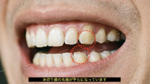 歯軋りで歯の先端がすり減っています