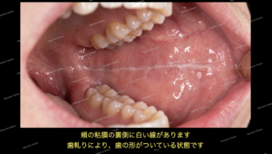 歯軋りにより、粘膜に歯の形が白い線として現れています