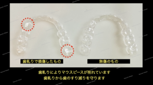 歯軋りによるすり減りをマウスピースで守ります